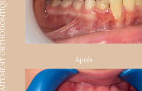 Avant ➜ Après | 6 mois de traitement